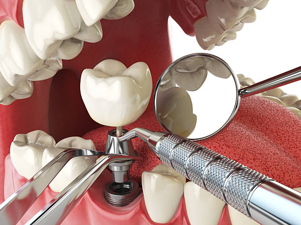 Best Emergency Root Canal Treatment in Big Bend, WI